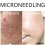Microneedling on-site training Incl. training documents & certificate