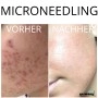 Microneedling training including training documents & certificate