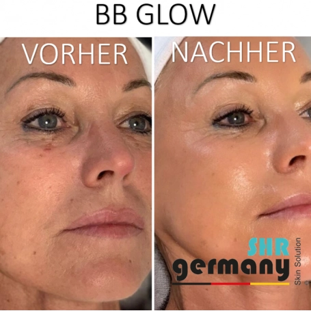 Meso BB Glow/ Microneedling/ Meso Lips authentic Schulung als Selbsstudium