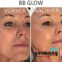 BB Glow + Microneedling Schulung mit Starterset & Zertifikat inkl. Derma Pen