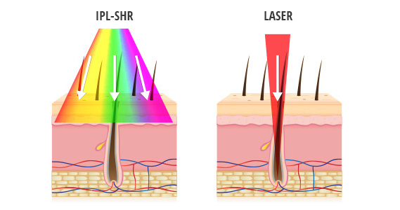 laser_ipl_1.jpg